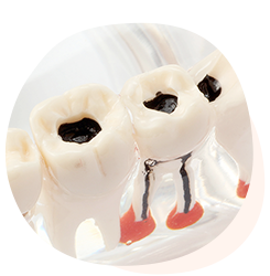 虫歯治療 歯が痛い・歯がしみる