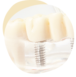 インプラント 入れ歯が合わない しっかりものを噛みたい