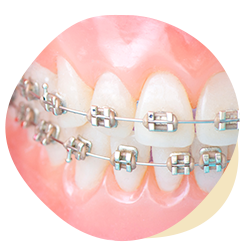 矯正歯科 歯並びが凸凹でなおしたい 子どもの歯並びが気になる